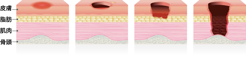 什麼是褥瘡、壓瘡、壓傷?