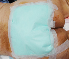 壓力性損傷(褥瘡、壓瘡、壓傷)治療