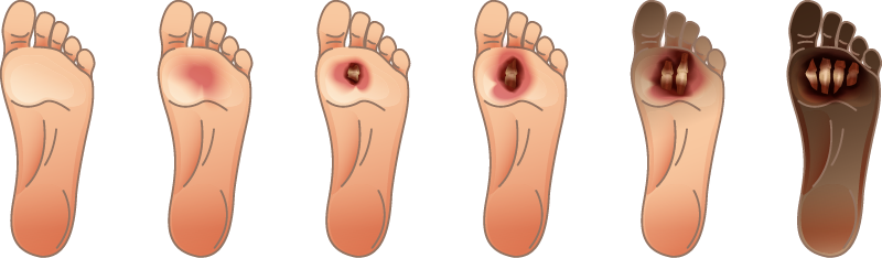 什麼是糖尿病足