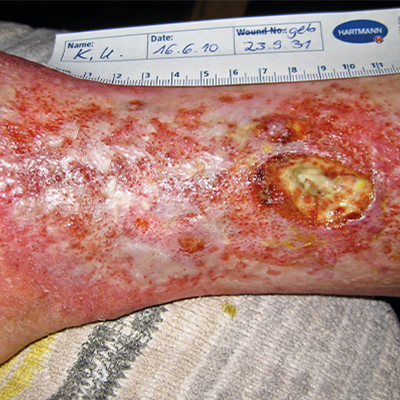 足部潰瘍的危險因子