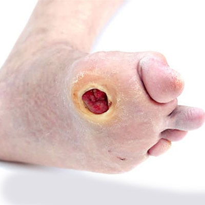 足部潰瘍的危險因子