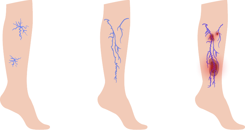 什麼是足部潰瘍